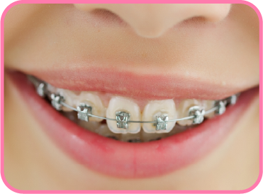 Braces for Teens. What parents in Kerala should know?