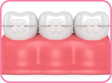 Braces for Teens. What parents in Kerala should know?